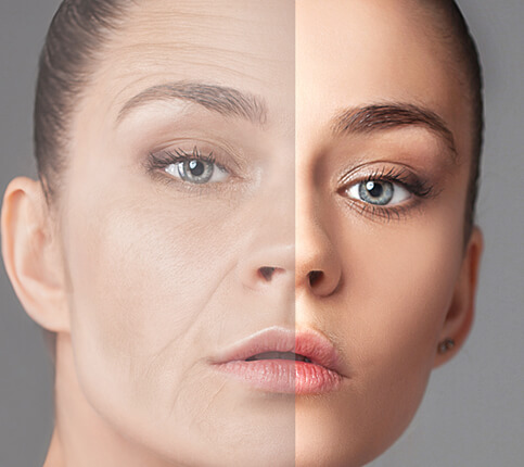 Fat Injection to the Face