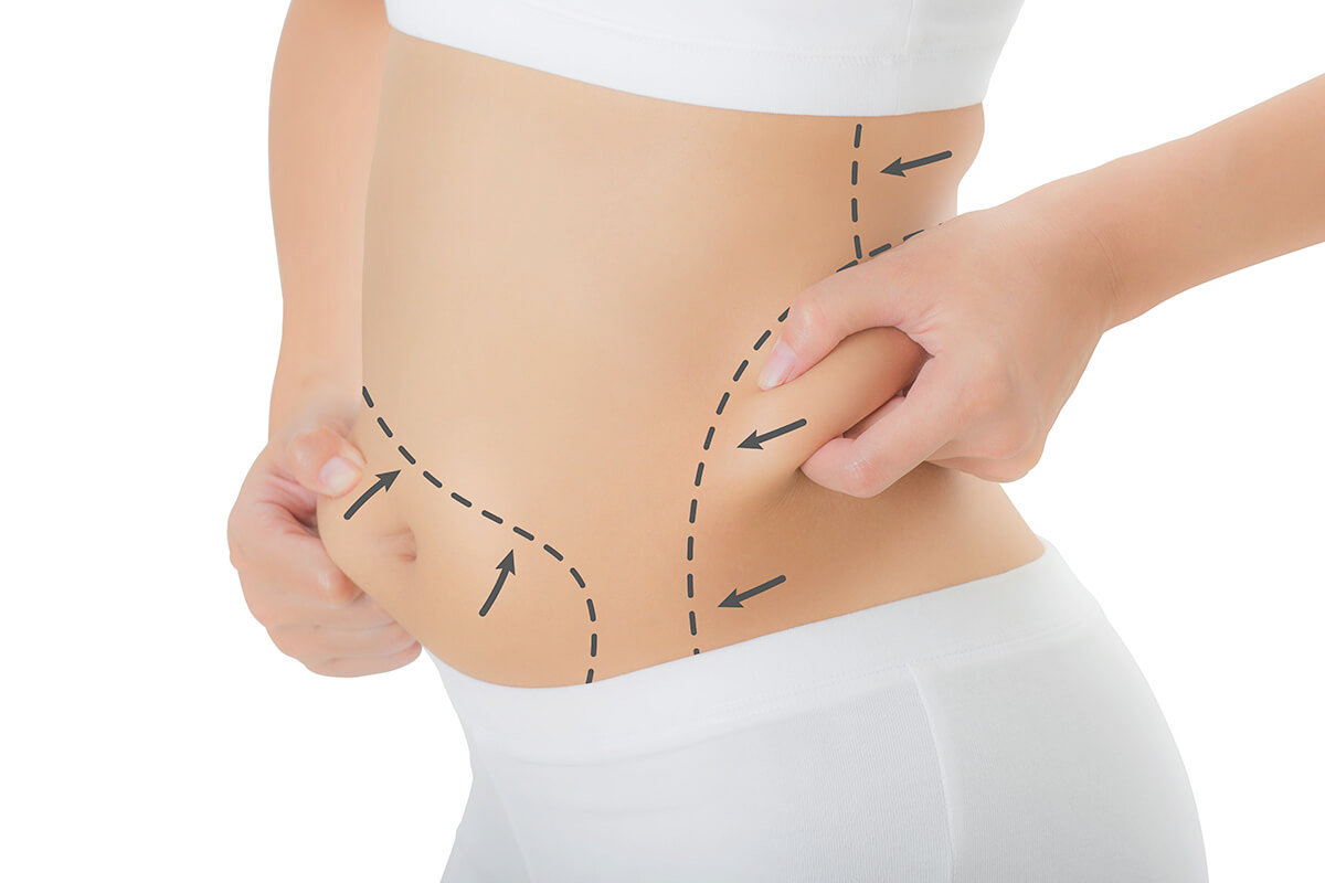 Liposuction